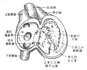 三尖瓣發(fā)育異常